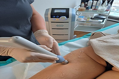 Shockwave za celulit, jedan tretman.Popust